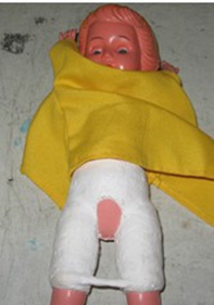 <p><span>pelvic affection</span></p>