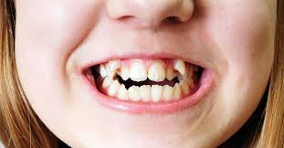 <p>alteración en posición dental por problemas en crecimiento maxilar/ mandibular</p>