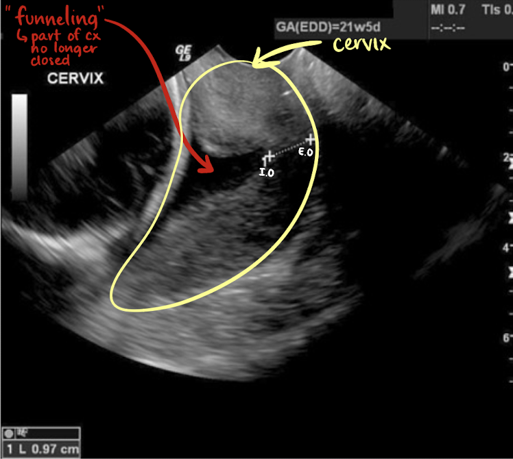 <ul><li><p>when<span style="color: red;"> CL is less than 2.5 cm</span></p></li><li><p>cervix does not remain closed </p></li></ul><p></p>