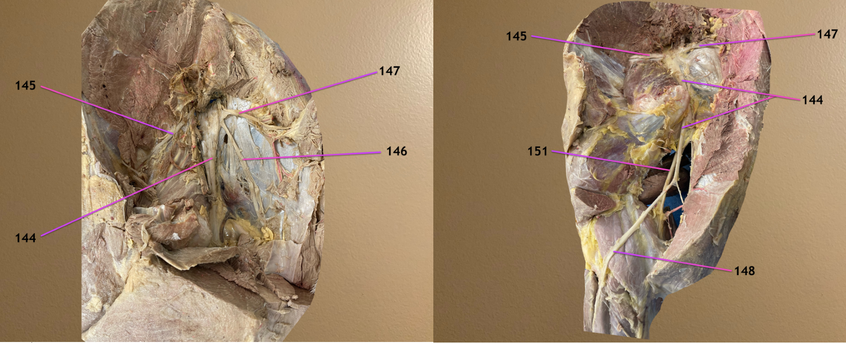 <p>left pic: lateral view of lumbosacral plexus </p><p>rt pic: caudal view</p><p>.</p><p>label 148, 151</p>