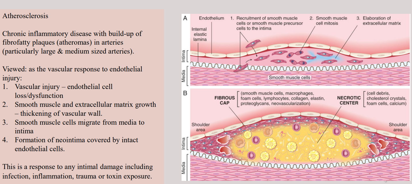 <p><span style="background-color: transparent; font-family: "Times New Roman", serif;">A compromise in coronary blood flow (often due to <strong>atherosclerosis</strong> or a <strong>thrombus</strong>) causes <strong>ischemia</strong>, which is more damaging than simple hypoxia because it also cuts off the delivery of glucose and the removal of toxic metabolites.</span></p>