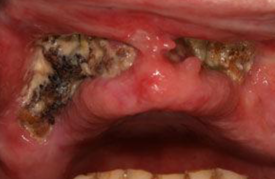 <p>radiation therapy induced exposed non vital bone that persists for more than 3 months in absence of neoplastic disease; occurs in < 5% of patients; most arise secondary to local trauma (ext), but some are spontaneous </p>