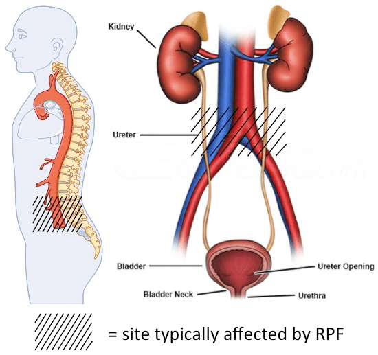 <p>A <strong><u>fibroinflammatory</u></strong> process that produces fibrous tissue around retroperitoneal structures</p><ul><li><p>Can <strong><u>encase</u> and <u>obstruct</u> the ureters</strong></p></li></ul><p>(Uncommon cause of ureteral narrowing or obstruction)</p>