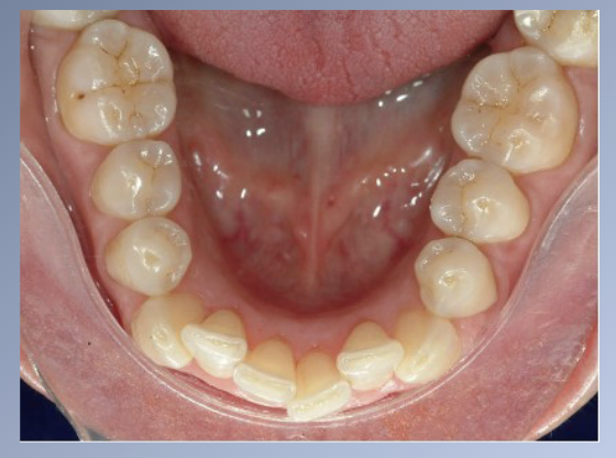 <p><span>Modern population:</span><br><span>• Strong tendency for crowding of the mandibular incisor teeth to develop in the late teens and early twenties.</span><br><span>• Theories:</span><br><span>1. Lack of “normal attrition” in the modern diet.</span><br><span>2. Pressure from the third molars.</span><br><span>3. Late mandibular growth</span></p>