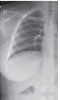 <p><span style="background-color: transparent;">&nbsp;AP/PA ribs</span></p>