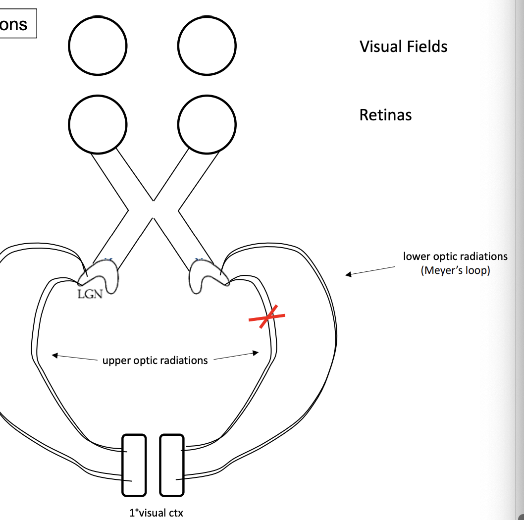 <p>pie shape, can see everything expect bottom left quarter of visual field</p>
