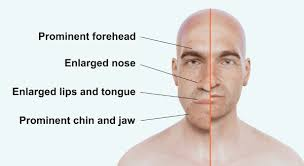 <p>A condition caused by <strong>excess growth hormone in adults</strong>, leading to <strong>enlargement of bones and tissues</strong>, especially in the <strong>hands, feet, and face</strong>.</p>