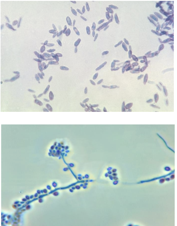 <p>-Causes: “rose gardener’s disease”</p><p>-Yeast: Cigar shaped, narrow based</p><p>-Mold: hyaline, septate with “rosettes) of microconidia</p>