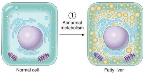 <p>normal cell converts to fatty liver cell w/ accumulation of fat molecules</p>