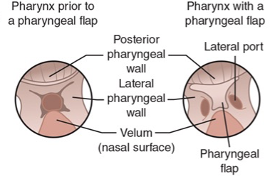 <p>What VPI surgery is this?</p>