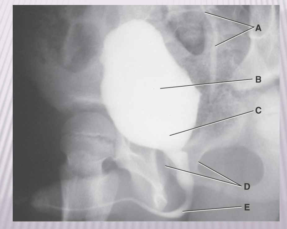 <p><span>Voiding Cystourethrogram</span></p>