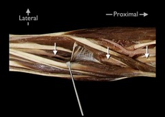<p>In this anterior view of the right elbow and forearm, identify the nerve indicated by the arrows.</p><p>Deep branch of radial nerve</p><p>Median nerve</p><p>Musculocutaneous nerve</p><p>Superficial branch of radial nerve</p>