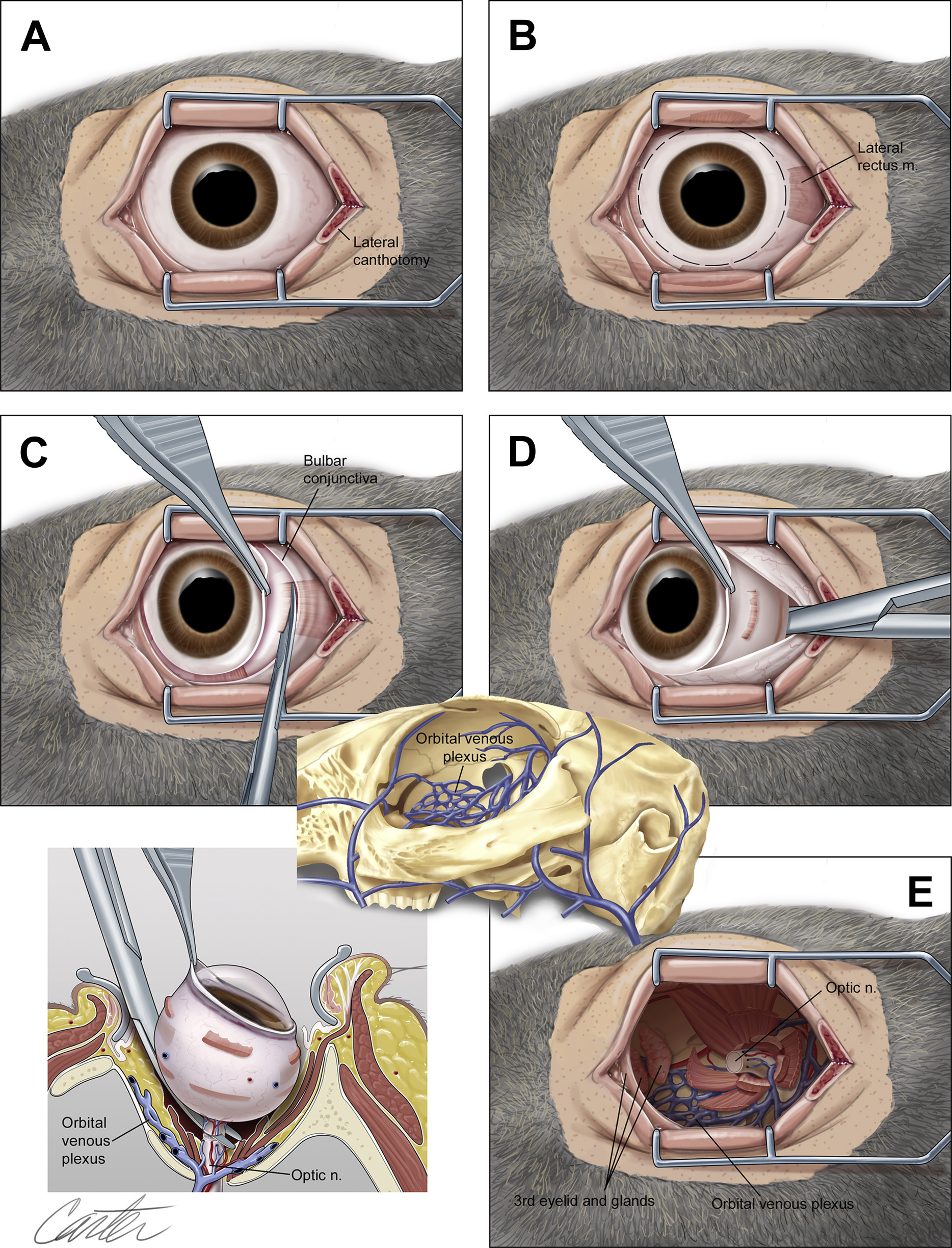 <p>Enucleation</p>
