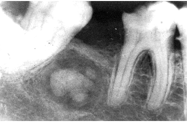 <p>central ossifying/ cementifying fibroma </p>