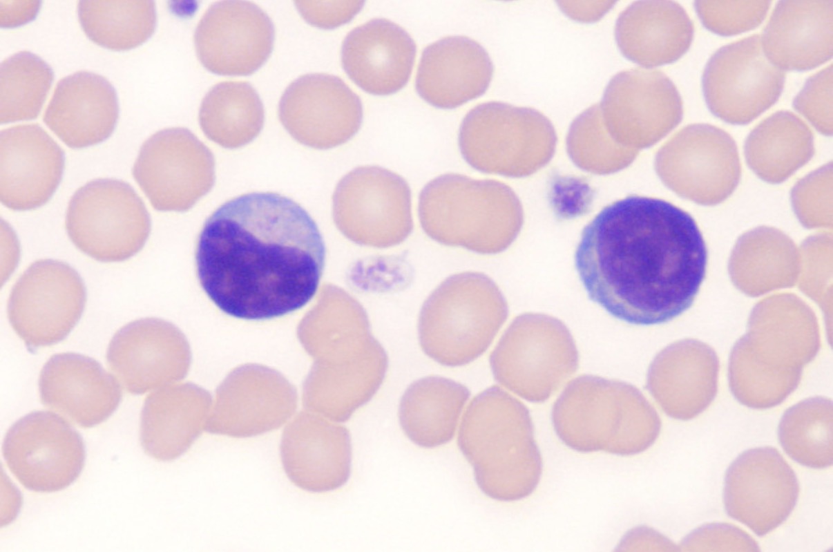 <p>Atypical lymphocytes with abundant cytoplasm and irregular nuclei, indicating a response to viral infections or other stimuli, commonly observed in infection or inflammatory conditions, increase in cytoplasmic basophilia, more likely to occur in b-lymphocytes and plasma cells</p>