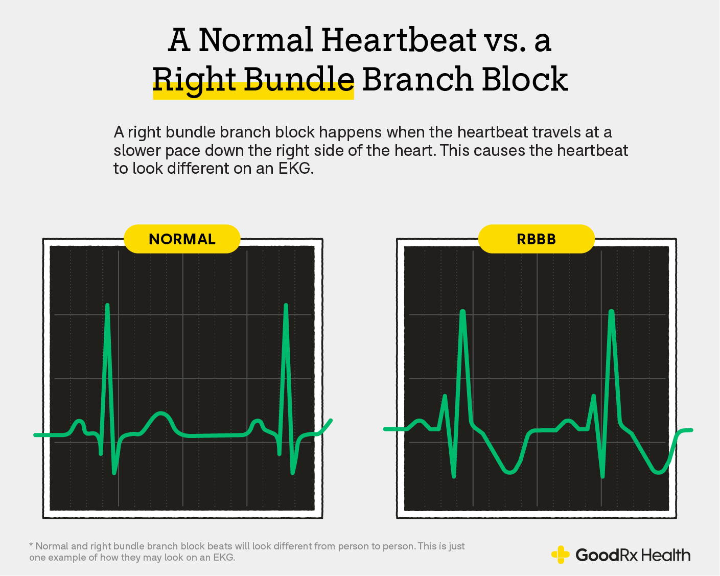 <p>Right bundle branch block </p>