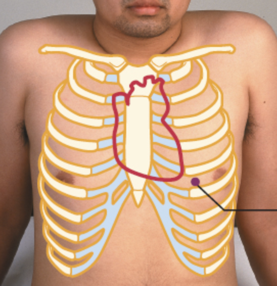 <p>Displaced apical impulse (normally 5th intercostal space).</p>