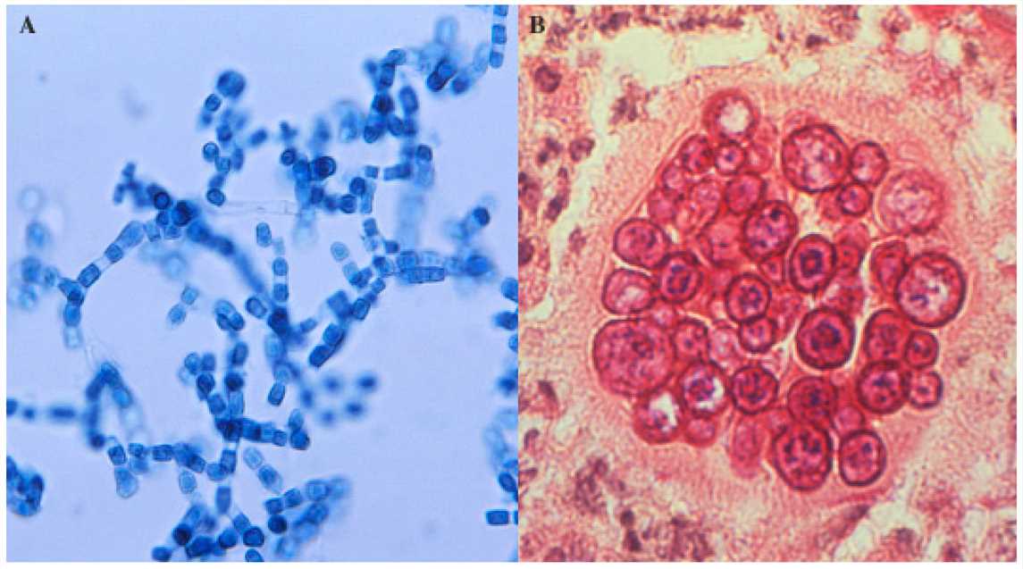 <p>What disease does <em>Coccidioides immitis</em> cause?</p>