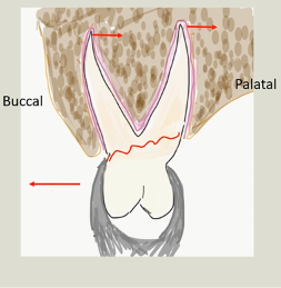 <p>Buccal force alone- <strong>rotation</strong> of tooth – root fracture - you also need to dilate the socket </p>