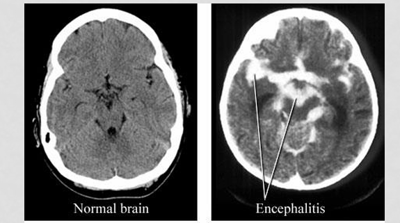 <p>significant edema and hemorrhage within the temporal lobes</p><p></p>