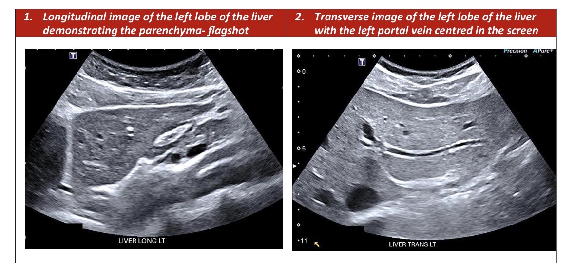 <p>Left Liver Longitudinal Survey</p>