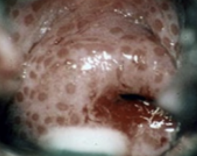 <p>🖼️‼️(#8)41.This cervical lesion can be seen in genital tract infections caused by: A.Candidiasis B.Trichomoniasis C.Herpes simplex type 2 D.Bacterial vaginosis</p>