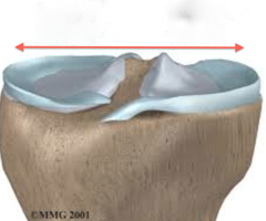 <p>Mostly injured combination of valgum & compression force to knee while flex</p>
