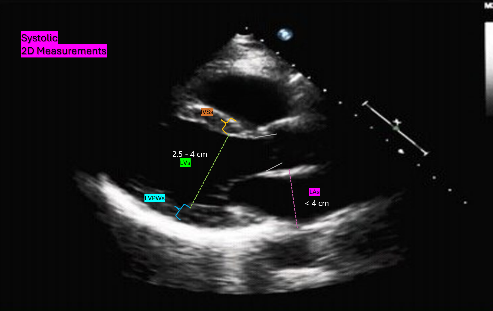 <p>LAs (Left Atrium systole) size < 4.0 cm</p>