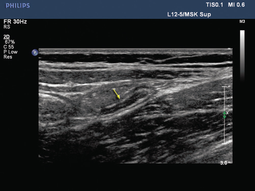 <p>7. The patient in Figure 16-17 complained of right lower quadrant pain and presented for a transabdominal pelvic sonogram. Upon closer presentation with a linear transducer, you noted the structure identified by the arrow. What is the most likely etiology of this structure?</p><p>a. Cecum</p><p>b. Rectum</p><p>c. Appendix</p><p>d. Sigmoid colon</p>