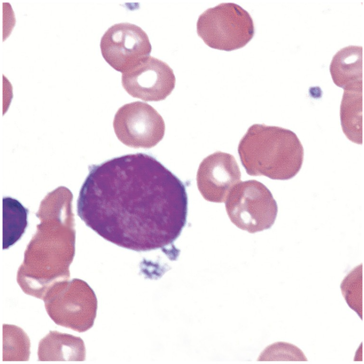 <p>what is a megakaryoblast?</p>