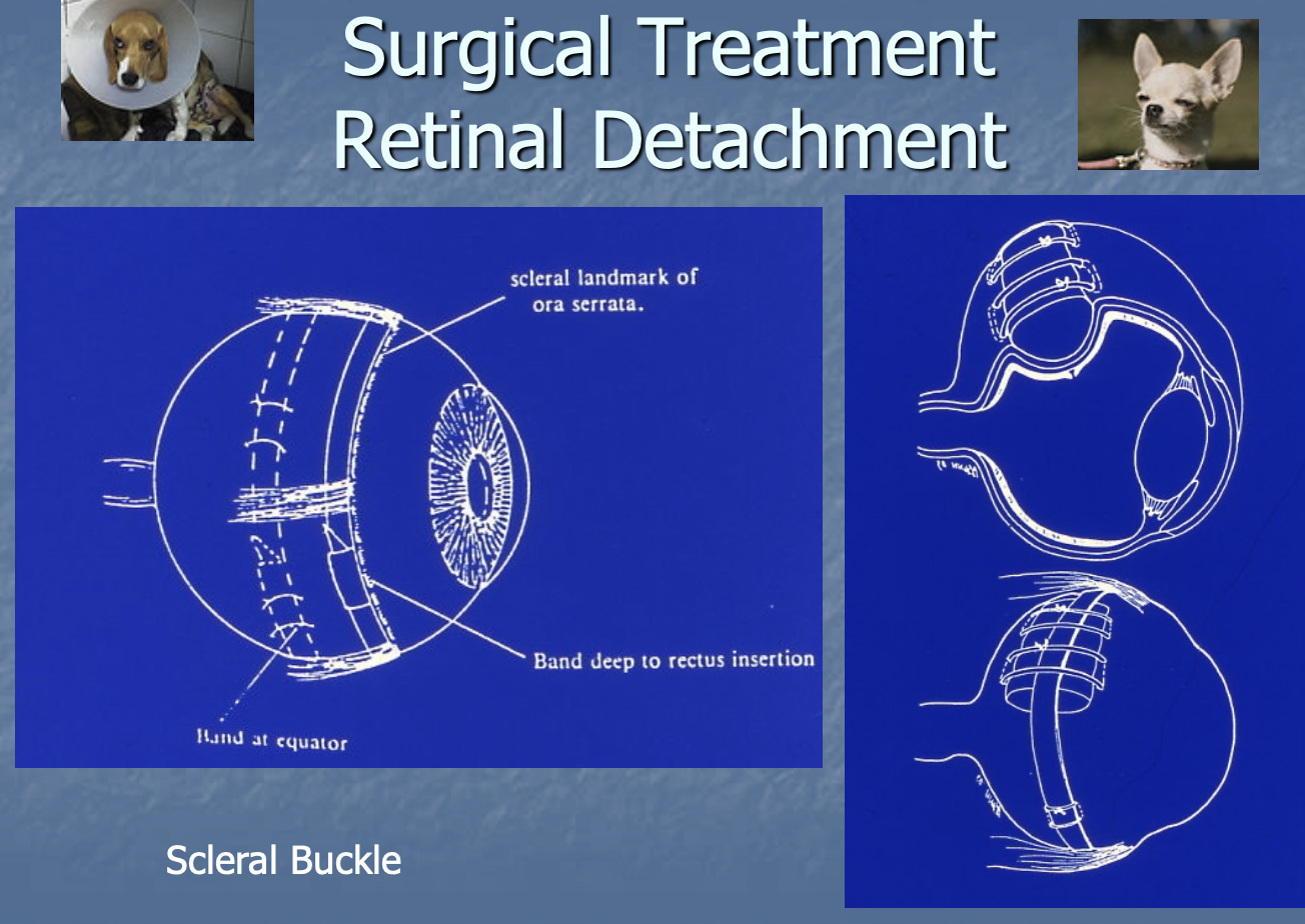 <p>scleral buckle</p><p>laser or cryo retinopexy </p>