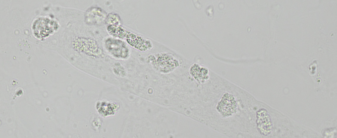 <p>Group of WBCs with cell matrix</p><p>Seen with Upper UTI’s, acute interstitial nephritis and glomerulonephritis </p>