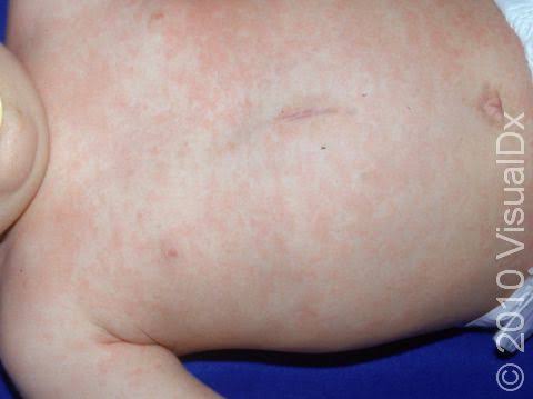 <p>when does the rash appear with <strong>roseola/sixth disease</strong>?</p>
