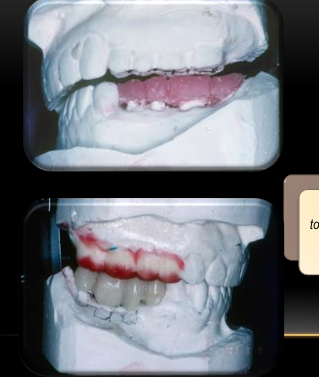 <p>-adjust the opposing teeth to the POC</p><p>-form provisionals whose occlusal surfaces conform to the new POC</p>