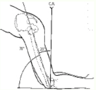<p>The patient position and central ray shown in the figure above will demonstrate the:</p>