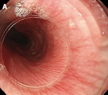<p>Normally closed to prevent air from entering esophagus </p><p>(prevents excessive eructation)</p>