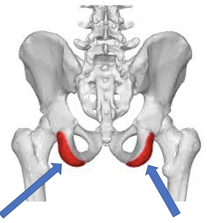 <p>The ischial tuberosity is a large, roughened projection that supports body weight when sitting and serves as a hamstring attachment site.</p>