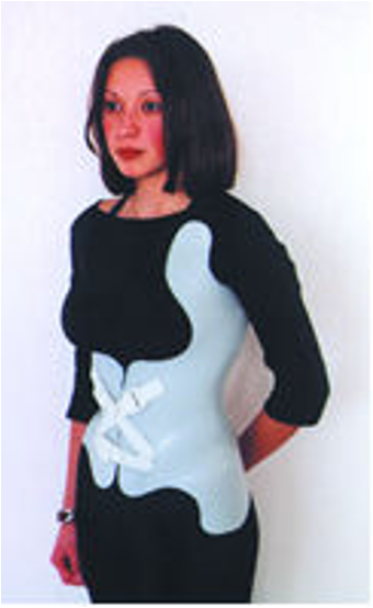 <p>rigid thermoplastic TLSO for scoliosis management</p>