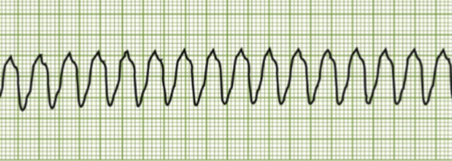 <p>Ventricle keeps contracting too early no P or T wave</p>