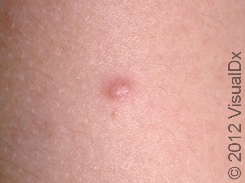 <p>A common benign fibrous skin growth, scar tissue growth</p>