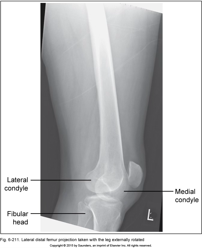 <p>lateral femur</p>