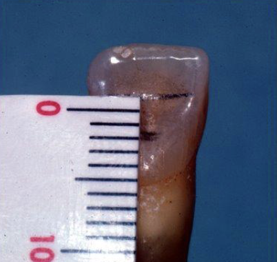 <p>Your access outline should be triangular in shape and 3mm×2mm in size. Why do you need to make an outline?</p>