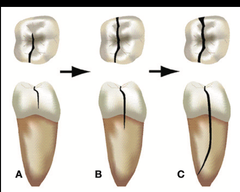 <p>continuation of a crack or vertical root fracture whereby the fx segments are <strong>completely separated</strong> longitudinally; can occur B/L or M/D</p>