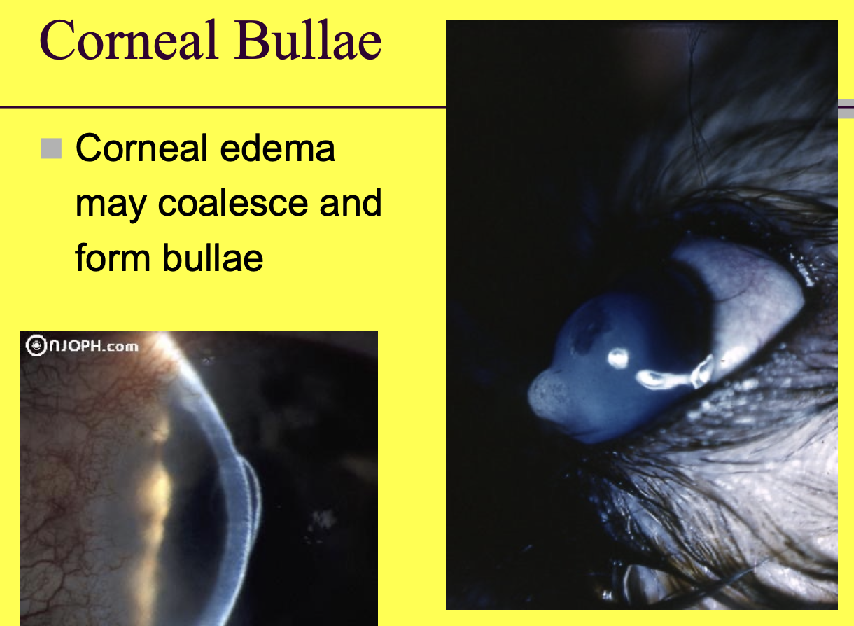 <p>when corneal edema coalesces, it can form bullae</p>