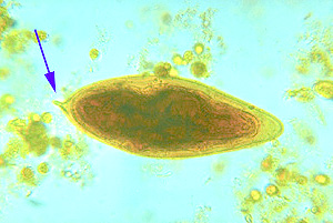 <p>This ova are most commonly found in urine sediments from patients complaining of frequent urination, dysuria, hematuria, and recurrent UTIs. What is the presumptive identification of this ovum?</p>