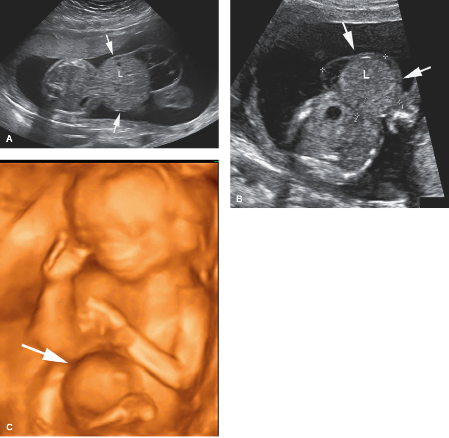 <p>Midline abdominal mass at the base of the umbilical cord that contains bowel, the liver, and/or other abdominal organs</p><p>Abnormal cord insertion into the midline abdominal mass</p><p>Multiple associated anomalies</p>