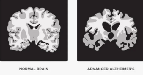 <p>accumulation of beta-amyloid plaques and neurofibrillary tangles distributed throughout the brain which degenerates neurons and synapses leading to atrophy of the cerebral cortex</p>