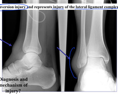 <p>Inversions injury</p>