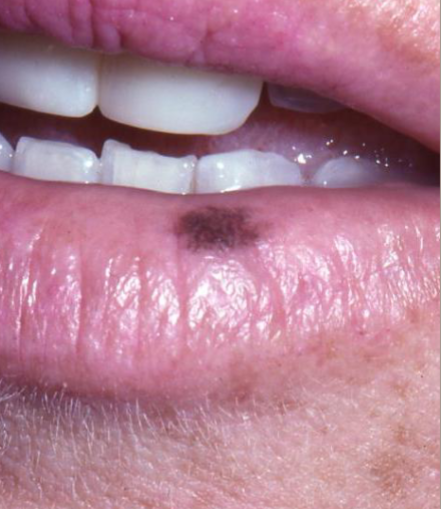 <p>Uniform brown pigmentation, oval w/ well demarcated borders. Most common on the lower lip vermillion, buccal mucosa, gingiva, palate. Will be a benign increase in melanin deposits</p>