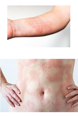 <p>What kind of lesion is this?</p>